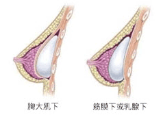 義乳植入後的位置選擇示意圖（電波拉皮,無痛佳醫美人,自體脂肪隆乳佳醫松江店,植髮30年整形經歷內湖佳醫美人,肉毒桿菌專業板橋佳醫）