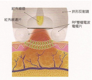 治療原理 (加速脂肪代謝、促進新陳代謝與肌膚膠原蛋白增生)（電波拉皮,無痛佳醫美人,自體脂肪隆乳佳醫松江店,植髮30年整形經歷內湖佳醫美人,肉毒桿菌專業板橋佳醫）